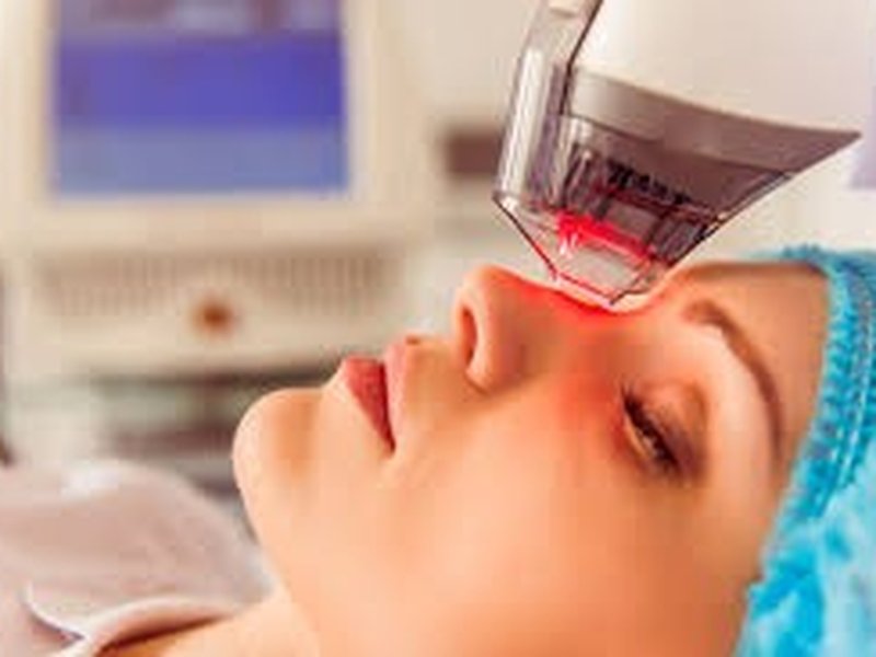 A medical laser handpiece held over a patient's face
